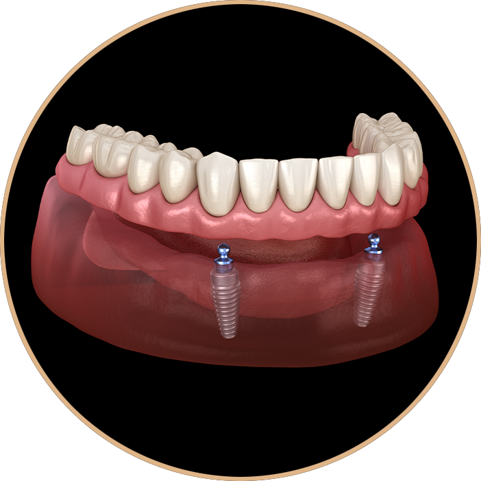 implant supported denture