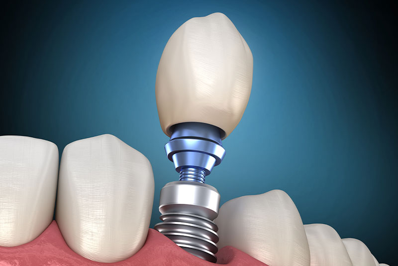 single dental implant